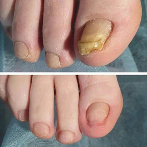 Unha Livre PRO – Solução Avançada para Unhas Saudáveis